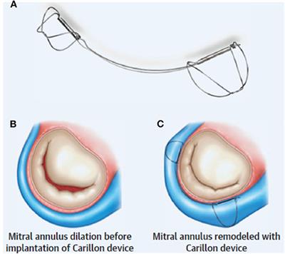 Indirect Mitral Annuloplasty Using the Carillon Device